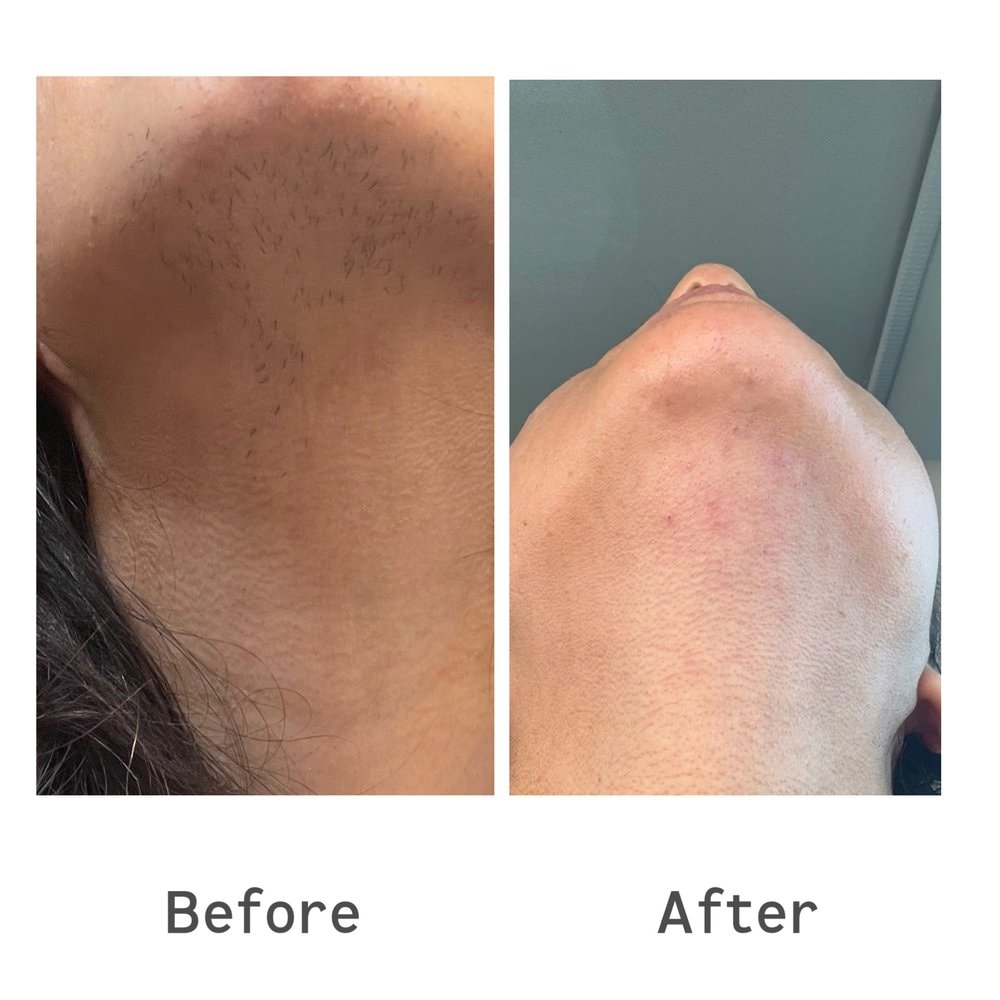 Before and after electrolysis result — chin hair removal